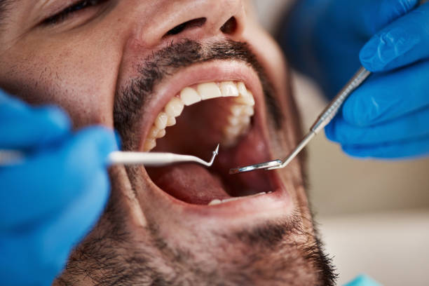 Best Emergency Tooth Extraction in Carrollton, GA